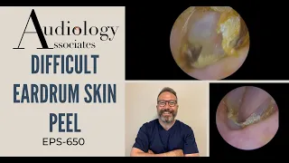 DIFFICULT EARDRUM SKIN PEEL - EP650