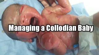 How to manage a Collodian Baby | Mother's Guide