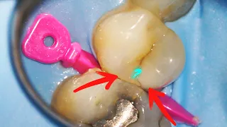 What's Inside a Massive Cavity Between the Teeth?