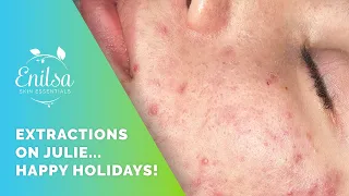 Happy Holidays! Blackhead extractions on our dear friend Julie 🥰