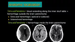 Radiology Dr Mamdouh Mahfouz CerebroVascular Stroke CT terminology and diagnosis for Clinicians