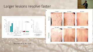 4/30/24 - Elevated Tryptase - Now What?