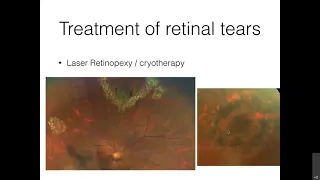 The Pantheo Lecture in Ophthalmology "Retinal detachment, causes,and modern treatment options"