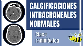 Calcificaciones de plexos coroideos, calcificación de glándula pineal