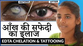 आँख की सफेदी का इलाज | A Combined Procedure (EDTA Chelation + Corneal Tattooing) for Corneal Opacity