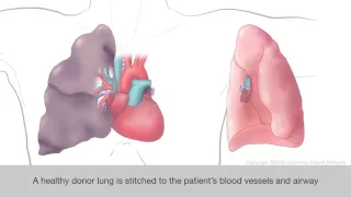 Lung Transplant Animation