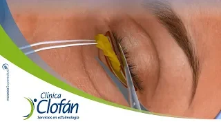 Blefaroplastia o cirugía de párpados - Clínica Clofán