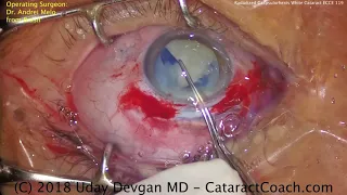 Radialized Capsulorhexis during ECCE for a dense white cataract