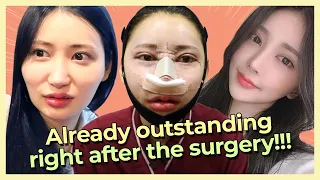 [Plastic Surgery Review] Double Eyelid Rhinoplasty and Facial Contouring DA Plastic Surgery in Korea