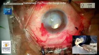 Big corneal opacity SICS optical iridotomy Dr Sourabh Patwardhan Live Cataract surgery