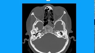 Neuroradiology spotters -Dr M Venkatesh