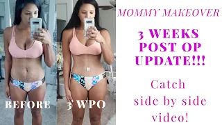 MMO 3 WEEKS Post Op UPDATE!!!  Faja Struggles and side by side comparison