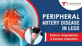 Peripheral Artery Disease in Legs | Balloon Angioplasty & Bypass Operation | Dr. Vijay Thakore #pad