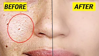 Even if you have pores and spots, it will dissolve in 1 night | Beauty Diy