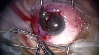 Excisional Biopsy of Pigmented Conjunctival Lesion