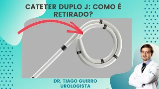 Cateter Duplo J: Como é Retirado?