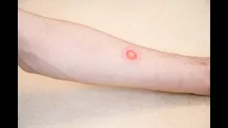 Is it ringworm? Signs and symptoms