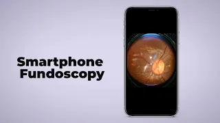 Smartphone Fundoscopy, turn any smartphone into fundus camera