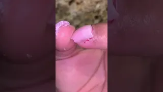 MY WHOLE NAIL RIPPED OFF…😱🤢 (UPDATE)