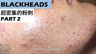 超密集的粉刺(blackheads) part 2 - Taiwan Tainan台南清粉刺最乾淨