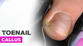 Toenail Callus | Callus Types and Treatment