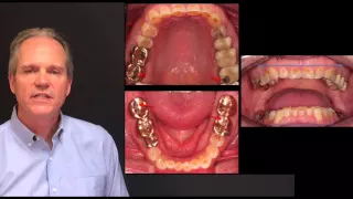 Vertical Dimension of Occlusion - Dr. Brian Mills