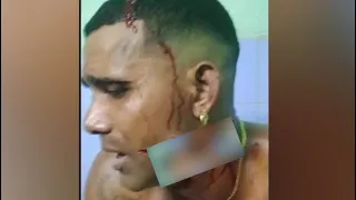 Le cortan la cara a un hombre en Cuba tras protagonizar violenta pelea