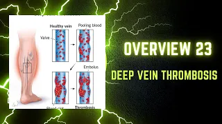 Overview 23 : Deep Vein Thrombosis