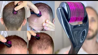 How I Use DermaRoller for Hair Growth and To Solve my Baldness and Hair Loss Tutorial 4k