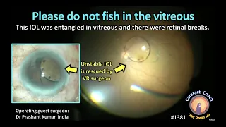 CataractCoach 1381: please do not fish in the vitreous!