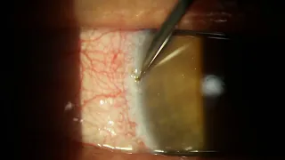 Removing Rust Deposits on Cornea with 21-Gauge Needle