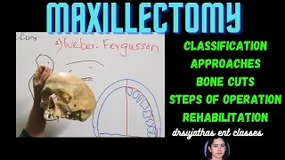 149.Surgery of Maxilla  #Total Maxillectomy #surgeryeducation #medicaleducation