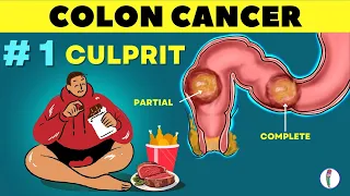 # 1 🔥 Cause of Colon Cancer & how to prevent it | Colon Cancer - causes | Rectal cancer