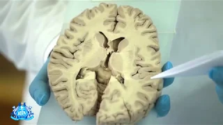 Базальные ядра головного мозга