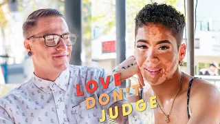 How Will My Blind Date React To My Vitiligo? | LOVE DON'T JUDGE