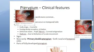 Ophthalmology 096 b Pterygium PseudoPterygium Probe test Complications