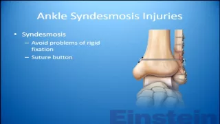 Any consensus on the syndesmosis? An update