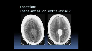 Intro to Head CT Part III: Tumor and Infection