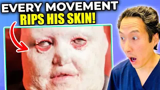 Plastic Surgeon Reacts to Man Whose Skin Falls Apart! EXTREME Bodies Explained!