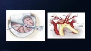 Clipping of Posteriorly Projecting Anterior Communicating Artery Aneurysm