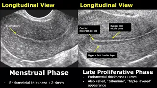 Endometrial Thickness Ultrasound Image Appearances | Endometrium Menstrual Cycle USG Images