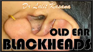 OLD EAR COMEDONES REMOVAL by Dr Lalit Kasana