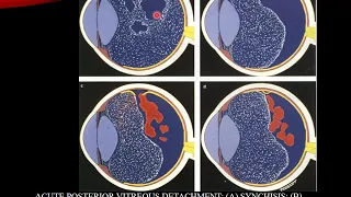 Retinal Detachment Lecture