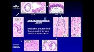 2021 Classic Lectures in Pathology: What You Need to Know: Breast Pathology- A CME Teaching Activity