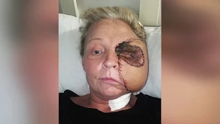 FLESH EATING Bug Causes Mother to Lose Half Her Face - Medical Surgery