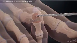 Minimally Invasive Hammertoe Deformity Correction