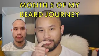 Minoxidil Beard | Month 5 of my Beard Journey