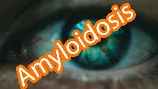 Amiloidosis -Symptoms and Treatment
