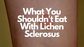 Foods to Avoid With Lichen Sclerosus & Possible Treatments