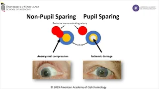 Cranial Nerve III Palsy